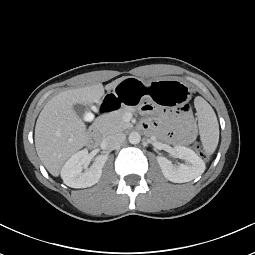 File:Acute uncomplicated appendicitis (Radiopaedia 61374-69304 Axial C+ portal venous phase 39).jpg