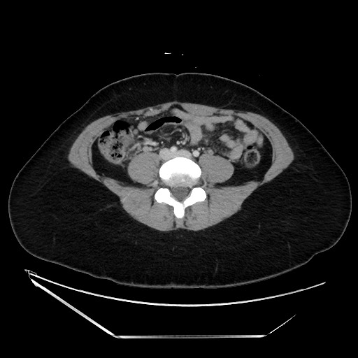 Acute uncomplicated appendicitis (Radiopaedia 73704-84499 Axial C+ portal venous phase 100).jpg