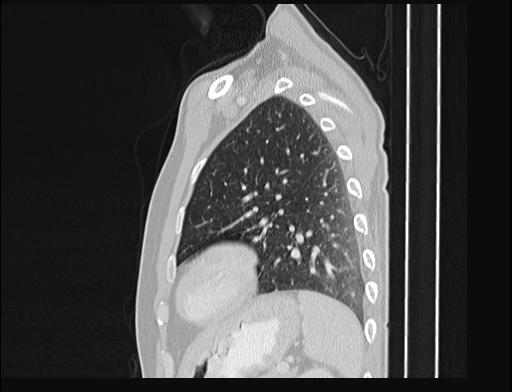 File:Addison disease (Radiopaedia 49318-54412 Sagittal lung window 15).jpg