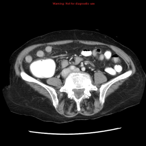 Adenocarcinoma of the colon (Radiopaedia 8191-9039 Axial liver window 48).jpg