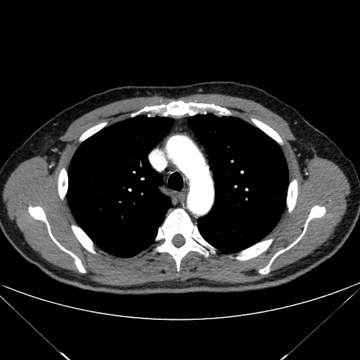 Adenocarcinoma of the lung (Radiopaedia 59871-67325 Axial C+ arterial phase 28).jpg
