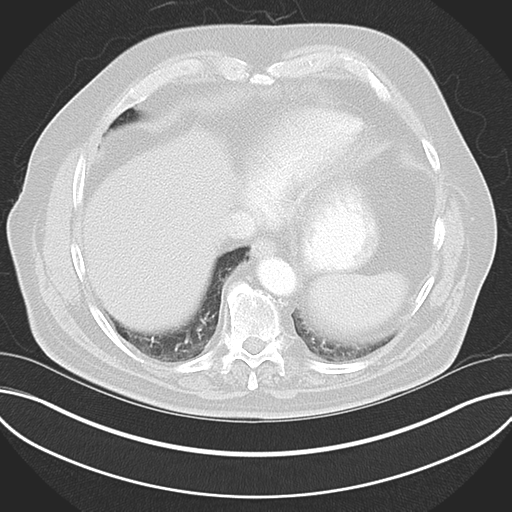 Adenocarcioma of rectum- T1 lesion (Radiopaedia 36921-38547 Axial lung window 44).png