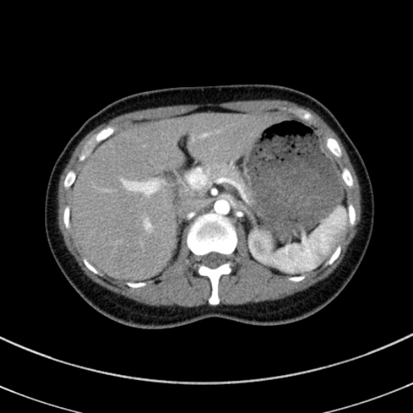 Adenocystic carcinoma of the trachea (Radiopaedia 47677-52525 Axial C+ arterial phase 80).jpg