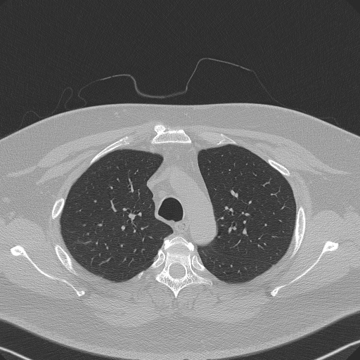 File:Adenoid cystic carcinoma of the trachea (Radiopaedia 49042-54137 Axial lung window 92).jpg