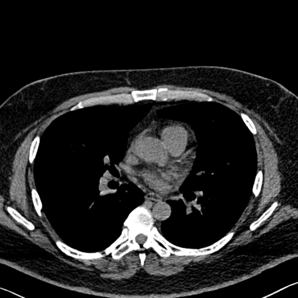 File:Adenoid cystic carcinoma of the trachea (Radiopaedia 49042-54137 Axial non-contrast 182).jpg