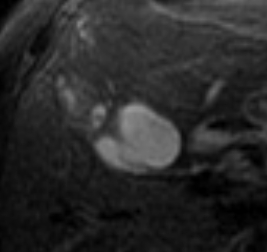File:Adenomyomatosis of the gallbladder (Radiopaedia 15878-15523 B 1).jpg