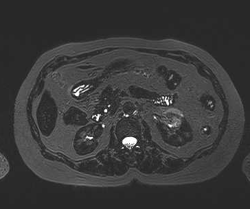 File:Adenomyomatosis of the gallbladder (Radiopaedia 50246-55587 Axial 23).png