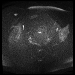 File:Adenomyosis-scar endometriosis (Radiopaedia 65863-75022 Axial DWI 10).jpg