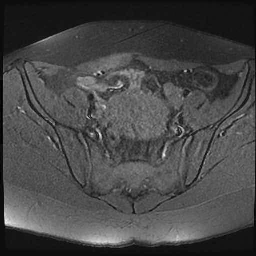 File:Adenomyosis-scar endometriosis (Radiopaedia 65863-75022 Axial T1 fat sat 8).jpg