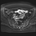 File:Adenomyosis and endometriotic cysts (Radiopaedia 82300-96367 Axial DWI 16).jpg