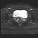 File:Adenomyosis and endometriotic cysts (Radiopaedia 82300-96367 Axial DWI 4).jpg