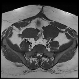 File:Adenomyosis within a didelphys uterus (Radiopaedia 70175-80215 Axial T1 17).jpg
