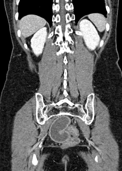 Adhesional small bowel obstruction (Radiopaedia 48397-53305 Coronal C+ portal venous phase 282).jpg