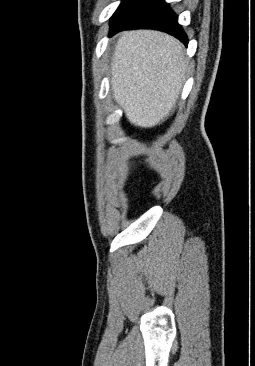 Adhesional small bowel obstruction (Radiopaedia 58900-66131 Sagittal C+ portal venous phase 26).jpg