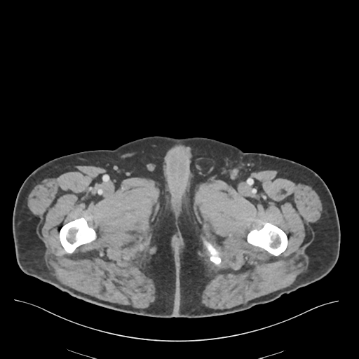 File:Adhesions within abdominal wall hernia (Radiopaedia 58283-65394 Axial C+ portal venous phase 94).png