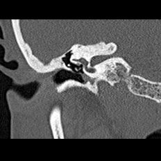 File:Adhesive chronic otitis media (Radiopaedia 14270-14148 Coronal bone window - right 10).jpg