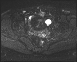 Adnexal multilocular cyst (O-RADS US 3- O-RADS MRI 3) (Radiopaedia 87426-103754 Axial DWI 16).jpg
