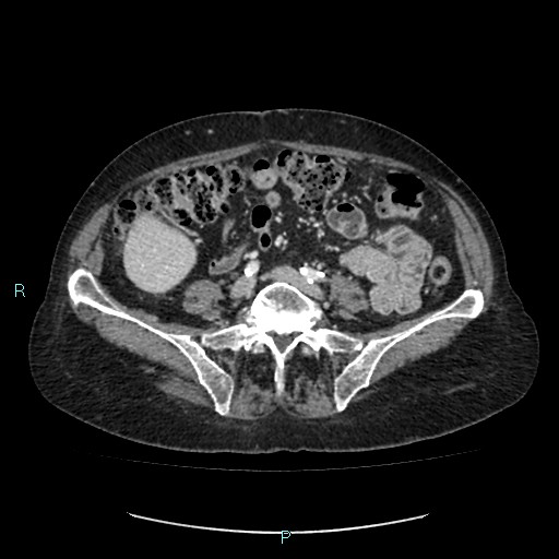 File:Adrenal collision tumor (ACT) (Radiopaedia 48462-53379 Axial C+ portal venous phase 40).jpg