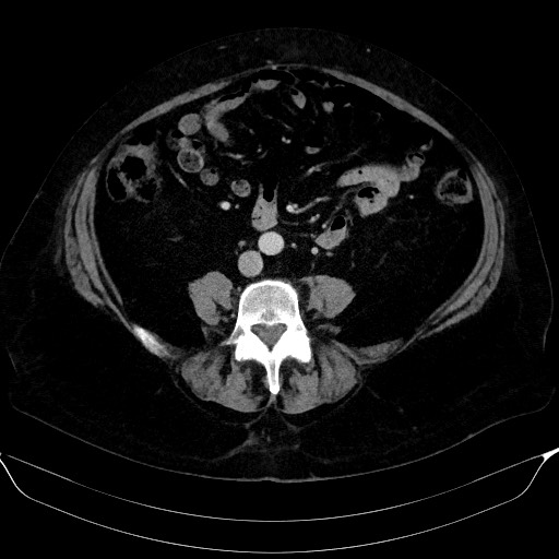 Adrenal cortical carcinoma (Radiopaedia 64017-72769 Axial C+ portal venous phase 43).jpg