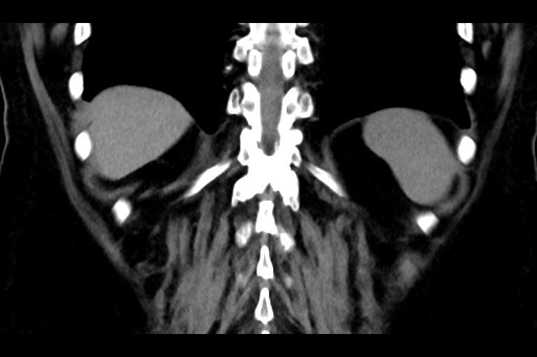 Adrenal cortical carcinoma (Radiopaedia 64017-72769 Coronal non-contrast 46).jpg