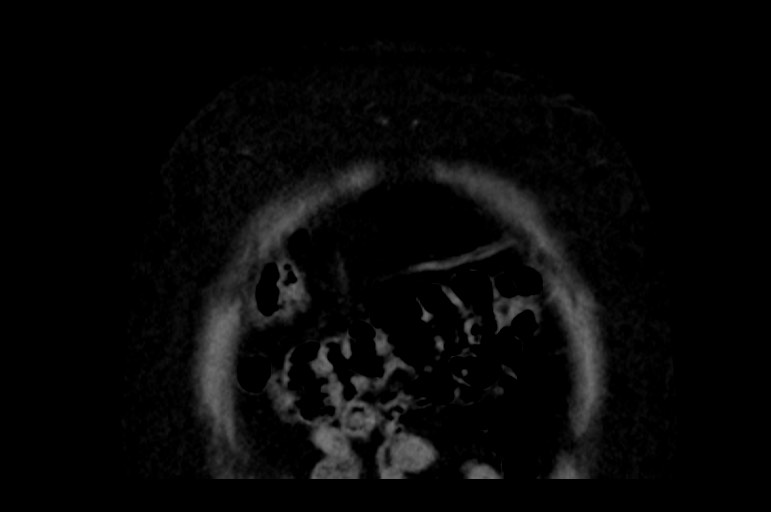Adrenal cortical carcinoma (Radiopaedia 64017-72769 Coronal non-contrast 6).jpg