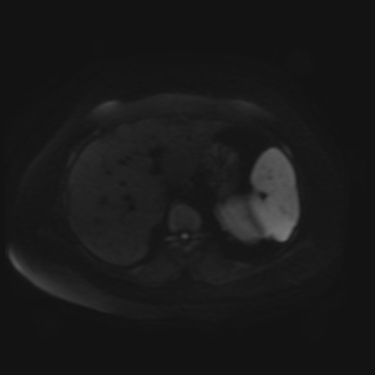 Adrenal cortical carcinoma (Radiopaedia 70906-81116 Axial DWI 36).jpg