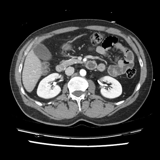 File:Adrenal gland trauma (Radiopaedia 81351-95078 Axial Dual bolus trauma C+ 72).jpg