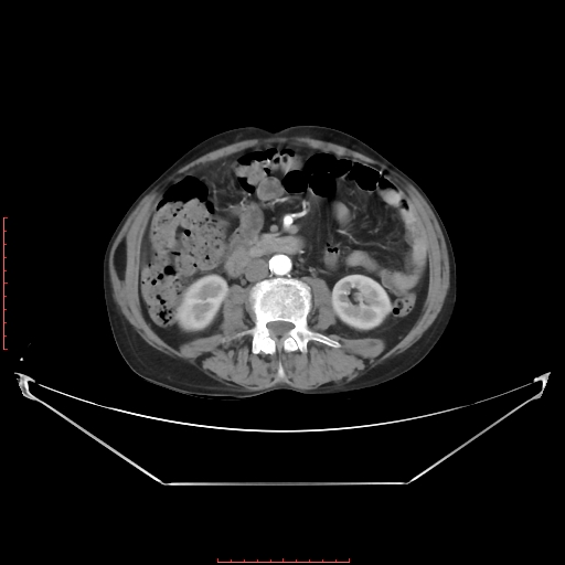 Adrenal hemangioma (Radiopaedia 68923-78668 Axial C+ arterial phase 40).jpg