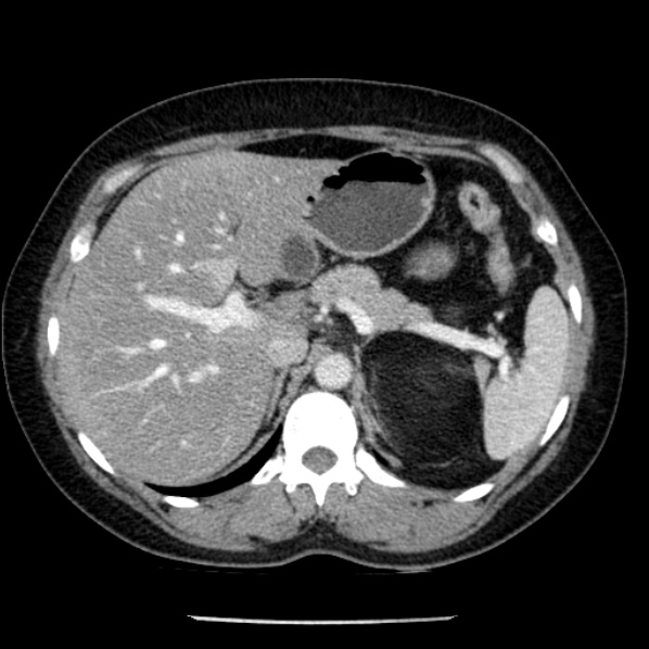 Adrenal myelolipoma (Radiopaedia 43401-46759 Axial C+ portal venous phase 22).jpg