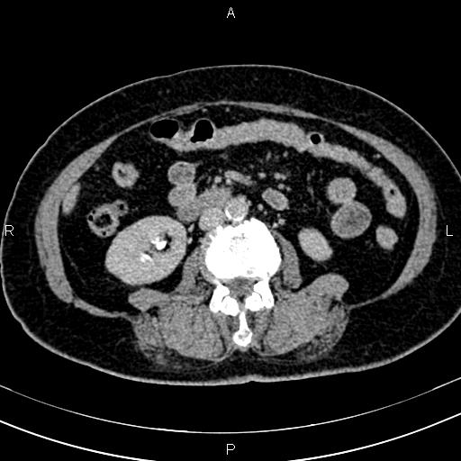 Adrenal myelolipoma (Radiopaedia 82742-96986 Axial renal excretory phase 79).jpg