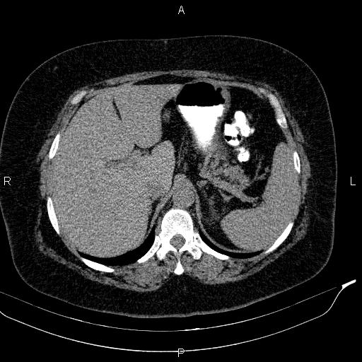 File:Adrenal myelolipoma (Radiopaedia 84319-99617 Axial With oral contrast 54).jpg