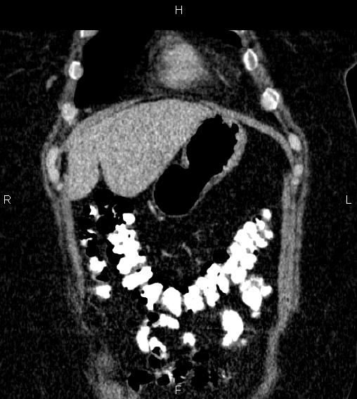 Adrenal myelolipoma (Radiopaedia 84319-99617 Coronal renal cortical phase 12).jpg