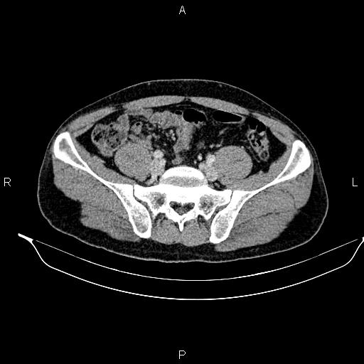 Adrenal myelolipoma (Radiopaedia 87794-104246 Axial renal cortical phase 79).jpg