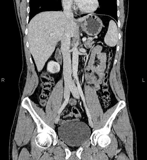 Adrenal myelolipoma (Radiopaedia 87794-104246 Coronal renal cortical phase 31).jpg