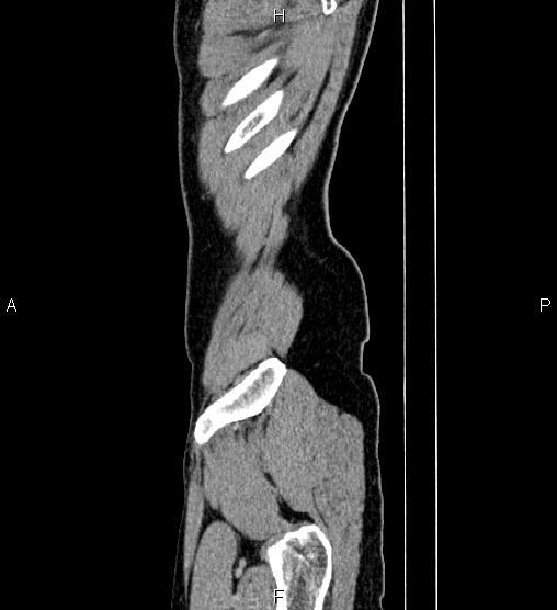 Adrenal myelolipoma (Radiopaedia 87794-104246 Sagittal renal cortical phase 93).jpg