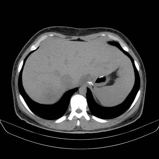 Adrenal myelolipoma - bilateral (Radiopaedia 74805-85810 Axial non-contrast 11).jpg