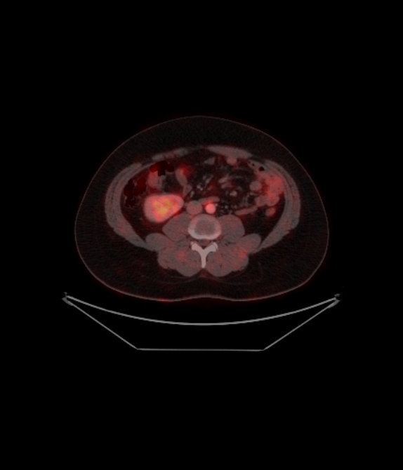 Adrenocortical carcinoma (Radiopaedia 80134-93440 ِAxial 194).jpg