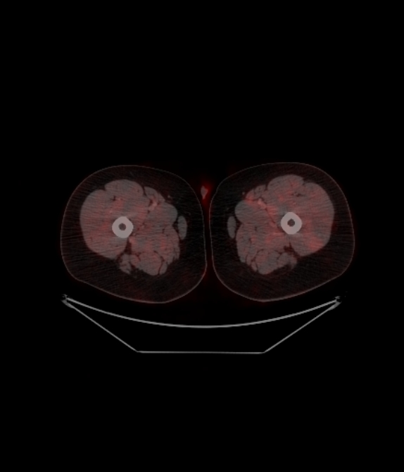 Adrenocortical carcinoma (Radiopaedia 80134-93440 ِAxial 297).jpg