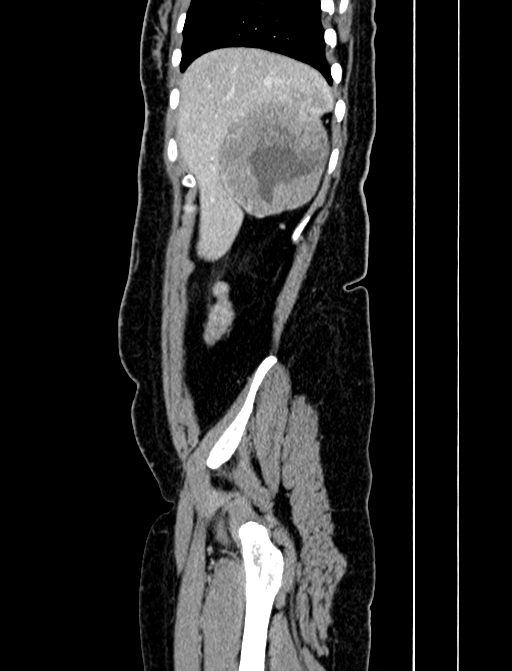 Adrenocortical carcinoma (Radiopaedia 87281-103569 Sagittal C+ portal venous phase 31).jpg