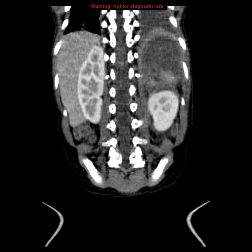 File:Adrenocortical carcinoma (Radiopaedia 9449-10131 Coronal C+ portal venous phase 17).jpg
