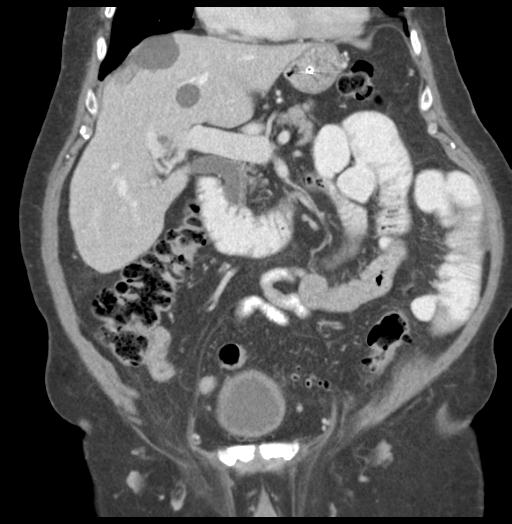 Adult ileal intussusception with secondary obstruction (Radiopaedia 30395-31051 Coronal C+ portal venous phase 26).jpg