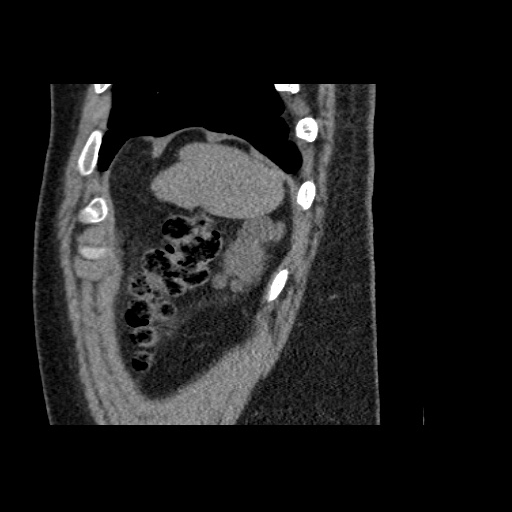 Adult polycystic kidney disease (Radiopaedia 59075-66368 Sagittal non-contrast 85).jpg