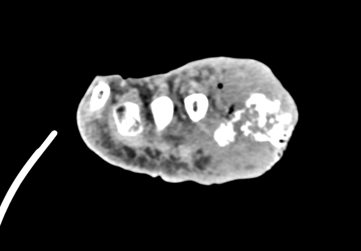 Advanced osteomyelitis due to open metatarsal fracture (Radiopaedia 83891-99095 Axial non-contrast 42).jpg