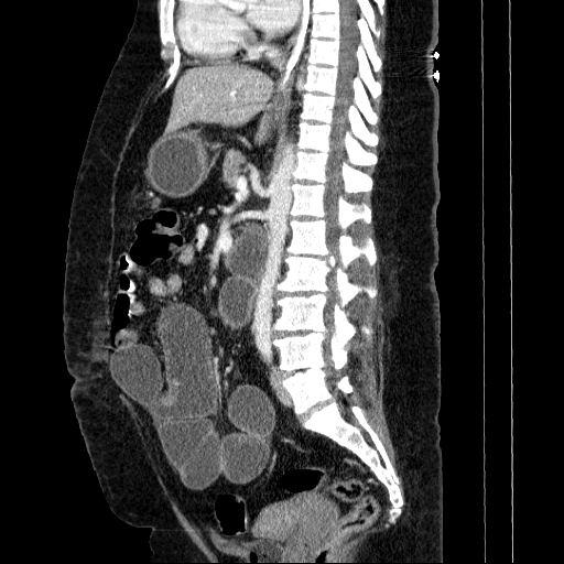 Afferent loop syndrome - secondary to incarcerated trocar site hernia (Radiopaedia 82959-97305 Sagittal C+ portal venous phase 75).jpg