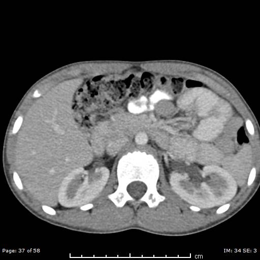 Agenesis of the gallbladder (Radiopaedia 55454-61905 B 37).jpg