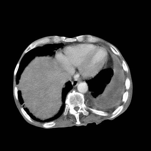 Aggressive lung cancer with cardiac metastases, pulmonary artery tumor thrombus, and Budd-Chiari (Radiopaedia 60320-67981 A 45).jpg