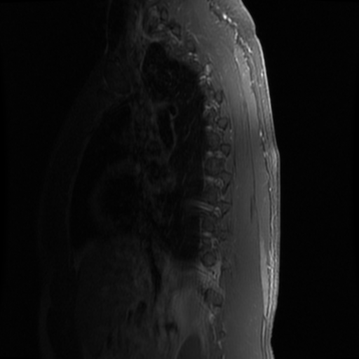 File:Aggressive vertebral hemangioma (Radiopaedia 39937-42404 B 17).png