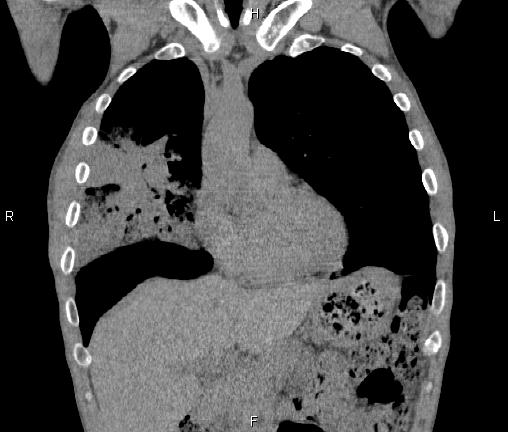 Air bronchogram in pneumonia (Radiopaedia 85719-101512 Coronal non-contrast 19).jpg
