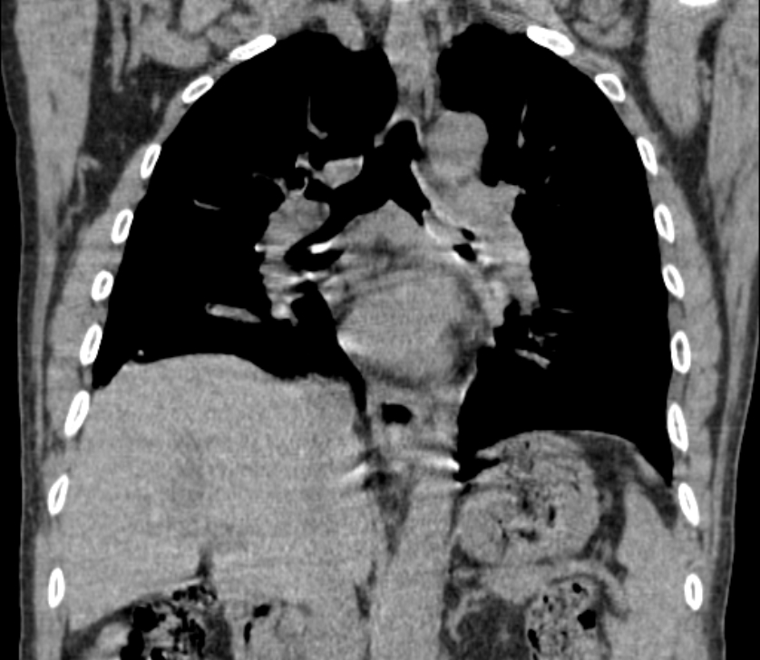 Airway foreign body in adult (Radiopaedia 85907-101779 Coronal liver window 151).jpg