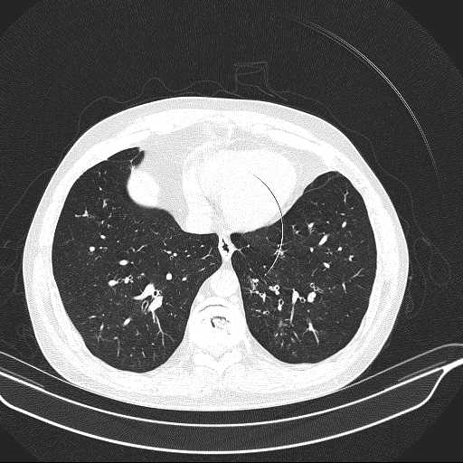 File:Allergic bronchopulmonary aspergillosis (Radiopaedia 21386-21320 Axial lung window 29).jpg
